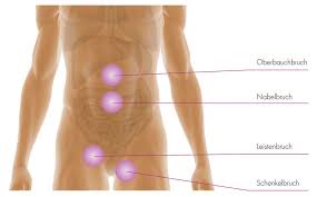 Die symptome können je nach stärke des. Bruche Hernien Der Bauchwand