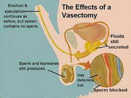 Will insurance cover a vasectomy. Management Solutions Insurance How Much Is A Vasectomy