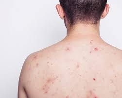 7 Punca Jerawat Badan Mylea Skin