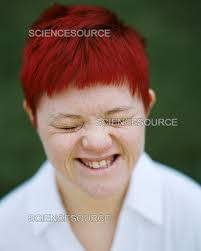Woman with Down's syndrome