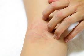 But accompanying symptoms depend on the type of skin cancer. 20 Skin Cancer Symptoms Everyone Needs To Know Best Life