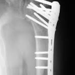 Synthes Proximal Humeral Locking Plate (Implant 206 ...