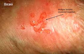 Image result for chancroid