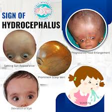 Image result for Hydrocephalus