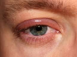 Here's how to get anything out of your eye weather it's an eyelash, dirt, san. Eye Disorders Understanding The Causes Symptoms And Management The Pharmaceutical Journal