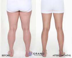 Calf Reduction Plastic Surgery Korea Reduction Surgery Plastic Surgery