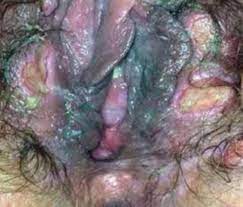 Here's a picture of blue waffle disease : r/worldpolitics