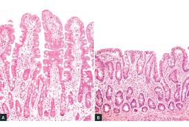 This often begins between six months and two years of age. Racgp Interpreting Tests For Coeliac Disease