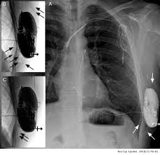 How does a pacemaker work? Inappropriate Shock Due To Air Entrapment In The Pocket Of A Subcutaneous Implantable Cardioverter Defibrillator Revista Espanola De Cardiologia