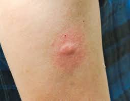 Maybe you would like to learn more about one of these? Como Distinguir Entre Picadura De Mosquitos Hormigas Y Aranas