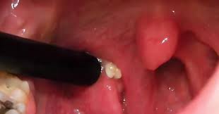 Maybe you would like to learn more about one of these? Tonsil Stones Symptoms And 10 Home Natural Treatments David Avocado Wolfe