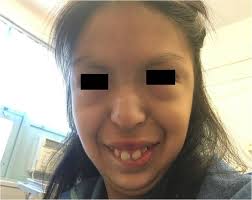 Clinical Medical & Alopecia Areata and Vitiligo in a Female with Al i  Syndrome (9p Deletion Syndrome)