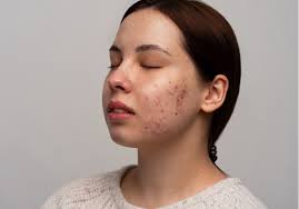 Jangan Pencet Jerawat di Hidung. Berbahaya!