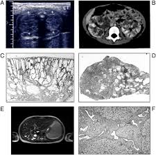 Autosomal Recessive Polycystic Kidney Disease A Hepatorenal Fibrocystic Disorder With Pleiotropic Effects American Academy Of Pediatrics