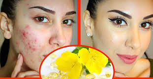 I think its because of that evening primrose oil and hypothyroidism. Evening Primrose Oil Benefits For Your Health