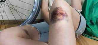 Pacientii cu hemofilie sangereaza mai mult timp decat ceilalti in urma unei leziuni si pot, de asemenea, sa. Wat Is Hemofilie Pfizer