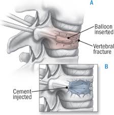 The team used the six generic headings to prompt ideas. Treating Osteoporotic Fractures Of The Spine Harvard Health