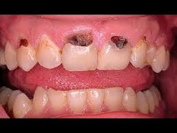 Natural Remedies Are Generally Available For Almost All Of Our Afflictions And They Do Not Have The Harmful Side Effect Teeth Health Rotten Teeth Heal Cavities