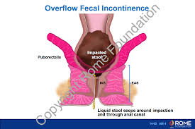 Image result for Fecal Incontinence