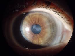 When Corneal Cross-Linking Goes Bad