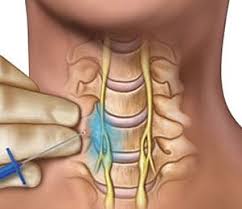 Have you ever felt a sharp pain under right breast when you breathe in deeply? Intercostobrachial Neuralgia Armpit Nerve Pain Dr Jason Attaman Seattle Pain Management Doctor