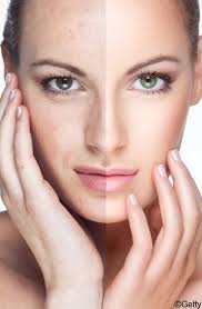 Epingle Par Dharani Koshy Sur Beauty Tips For Skin Taches Brunes Tache Peau Masque Visage Maison
