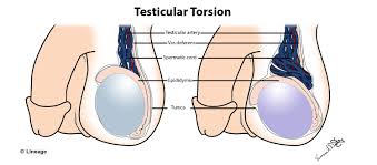 Know about its causes, treatment, symptoms as well as treatment in newborns and infants. Testicular Torsion Reproductive Medbullets Step 1