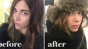 The official name is revanesse versa and it's a relatively new dermal filler. Lip Injections 9 Things I Wish I D Known Before Getting Them Glamour