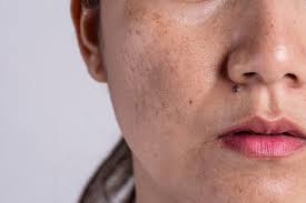 Download reflexzonen massage technik und gerte now! Home Remedies To Remove Dark Spots On The Face Be Beautiful India