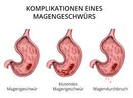 Blut im stuhl ist für den betroffenen zunächst ein großer schock, meistens sind die ursachen aber relativ harmlos. Magengeschwur