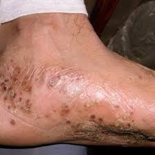 Image result for pompholyx soles of feet