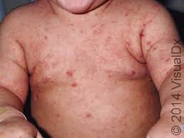 Image result for scabies human children