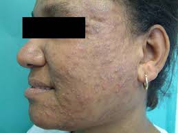 Inflammatory Noninfectious Dermatoses of HIV