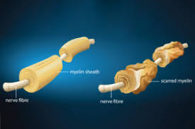 In ms the body's immune system attacks myelin, which coats nerve cells. Ayurvedic Treatment For Multiple Sclerosis Panchakarma
