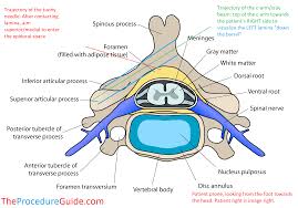 Image result for Lower Cervical Intramuscular Injection