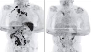 Lymphoma is a general term for cancers that start in the lymph system (the tissues and organs that produce, store, and carry white blood cells that fight infections). Lymphoma Is Largely Gone After Covid 19 Infection Nfcr