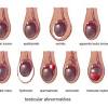 A painless one is a possible warning sign of testicular cancer. 1