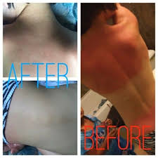 Mother Blogs Heal A Sunburn Overnight Naturally Sunburn Treatment Heal Sunburn Cure For Sunburn