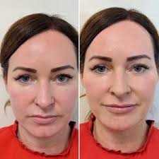 Why chin's are the new lips