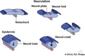 Image result for Spinal Dysraphism