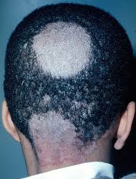 Ringworm doesn't tend to get better on its own, so the symptoms are likely to worsen if it isn't treated. Scalp Ringworm Tinea Capitis Skin Disorders Msd Manual Consumer Version