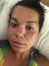 Accident with sea urchin in Hawaii