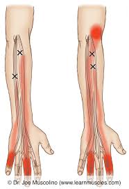 Ebraheim's educational animated video describes the anatomy of the extensor digiti minimi muscle in the forearm. Extensor Digitorum And Extensor Digiti Minimi Trigger Points Learn Muscles