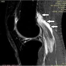 · 4, greater saphenous vein. Sagittal Pdw Spir Knee Mr Image Demonstrating Abnormal Bright Signal Download Scientific Diagram