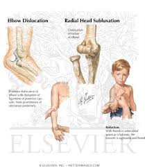 Elbow Dislocation Radial Head Subluxation