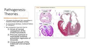 Image result for Left Ventricular Noncompaction