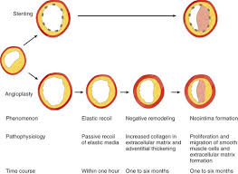 This can be an issue if you are hunting on ocean beaches. Imaging Of Coronary Revascularization Coronary Stents And Bypass Grafts Radiology Key