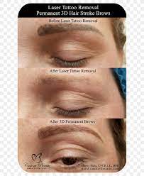 Interested in getting your eyebrow tattoos removed? Eyebrow Tattoo Removal Permanent Makeup Laser Png 667x1000px Eyebrow Cheek Chin Close Up Cosmetics Download Free