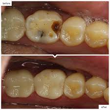 Taking months or even years to cause the type of damage that requires a filling, crown, and/or root canal therapy from your dentist. Cavity Filling Soho Smile