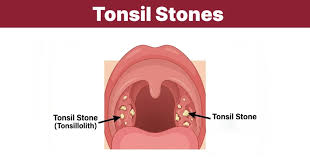 Image result for Tonsillolith